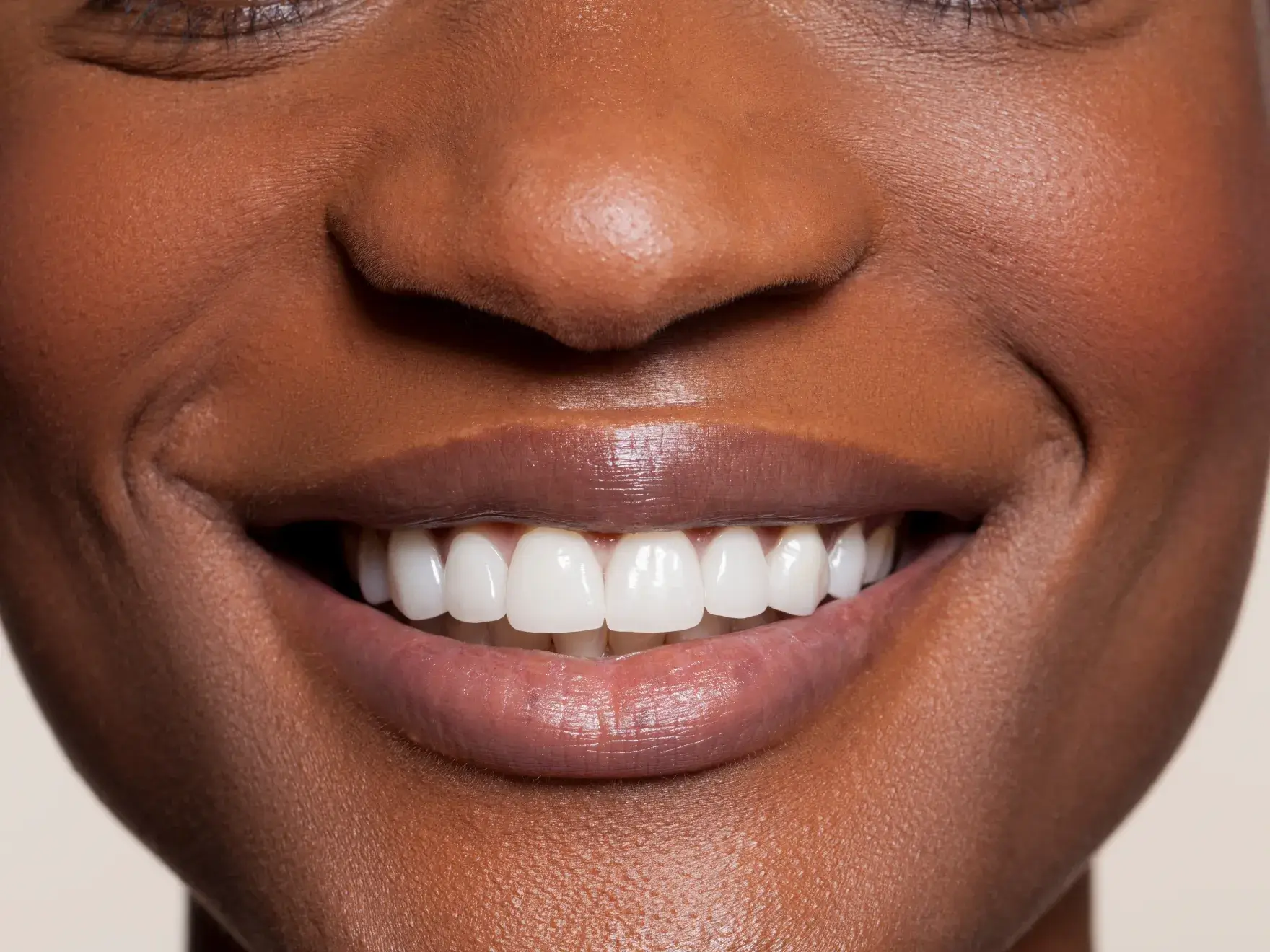 Teeth Whitening at Chesterfield Woodlake Dental